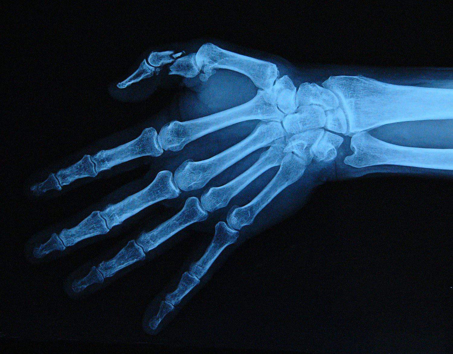 X-Ray of a male hand with severely broken thumb