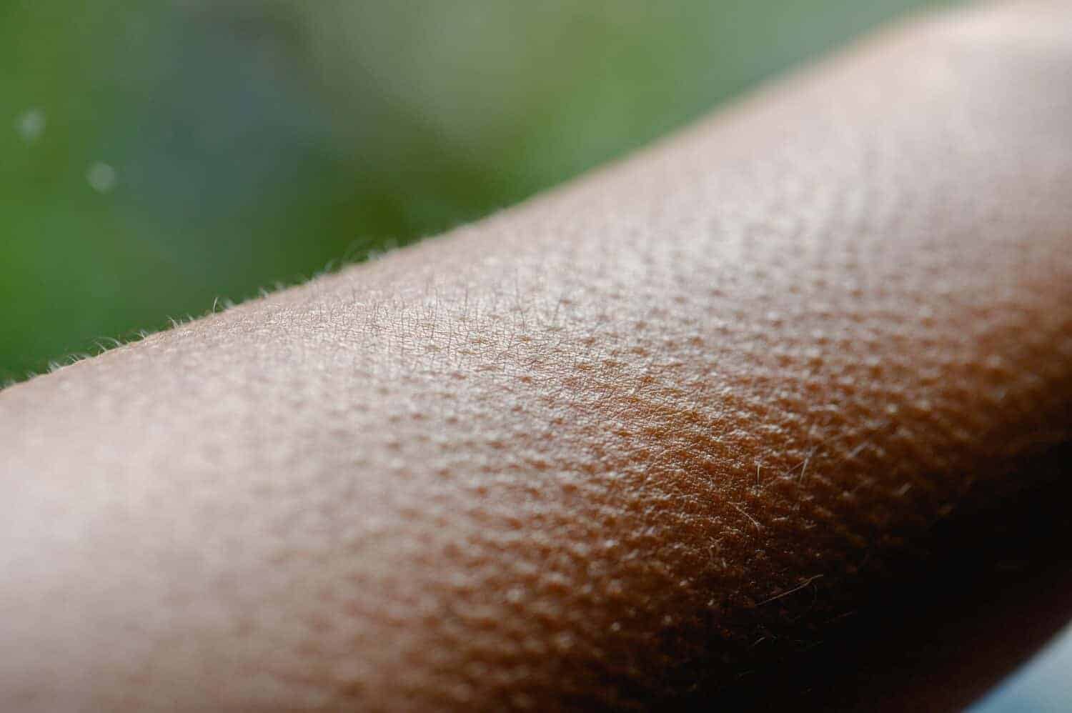 Goosebumps Are an Evolutionary Vestige