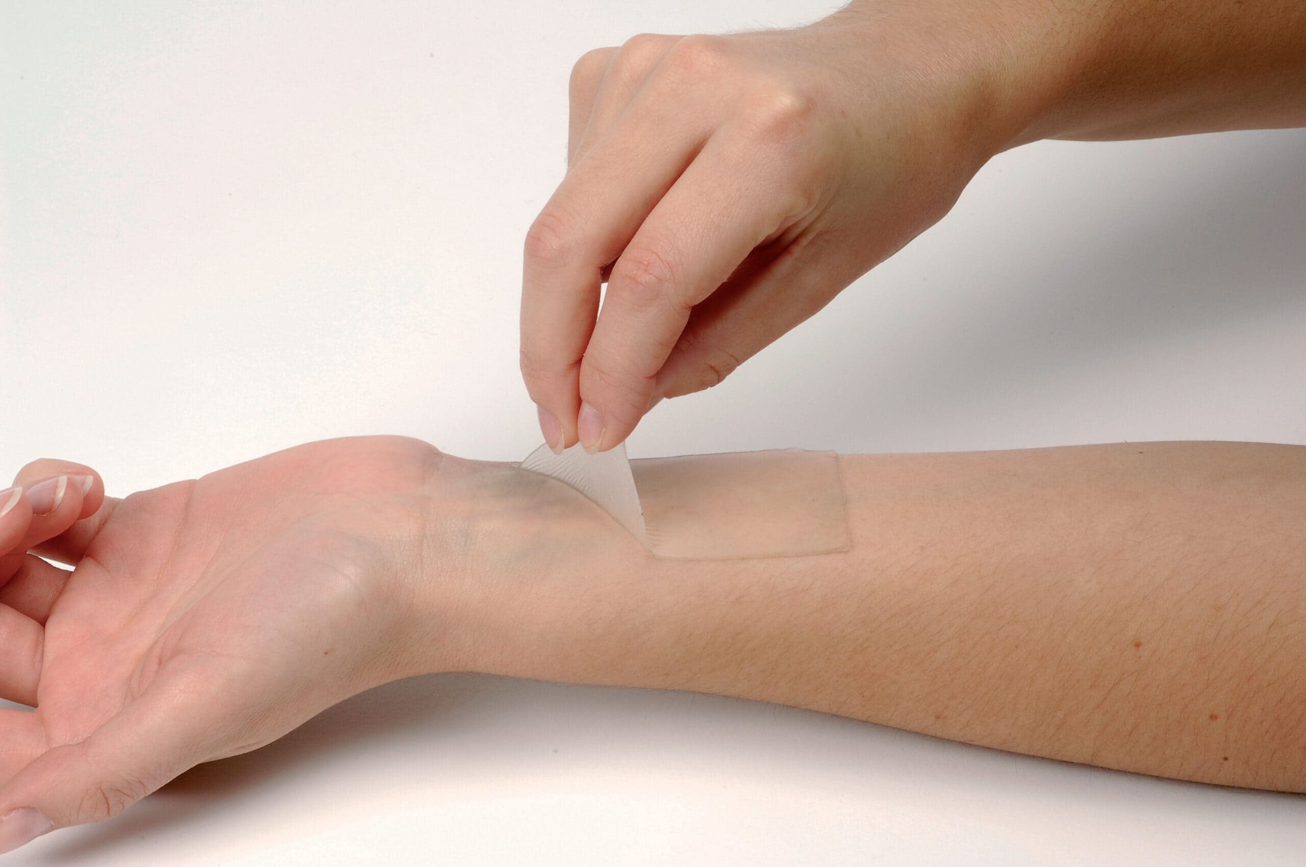 Mussel-Inspired Medical Adhesives
