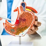 Stomach Ulcers Are Caused by Stress