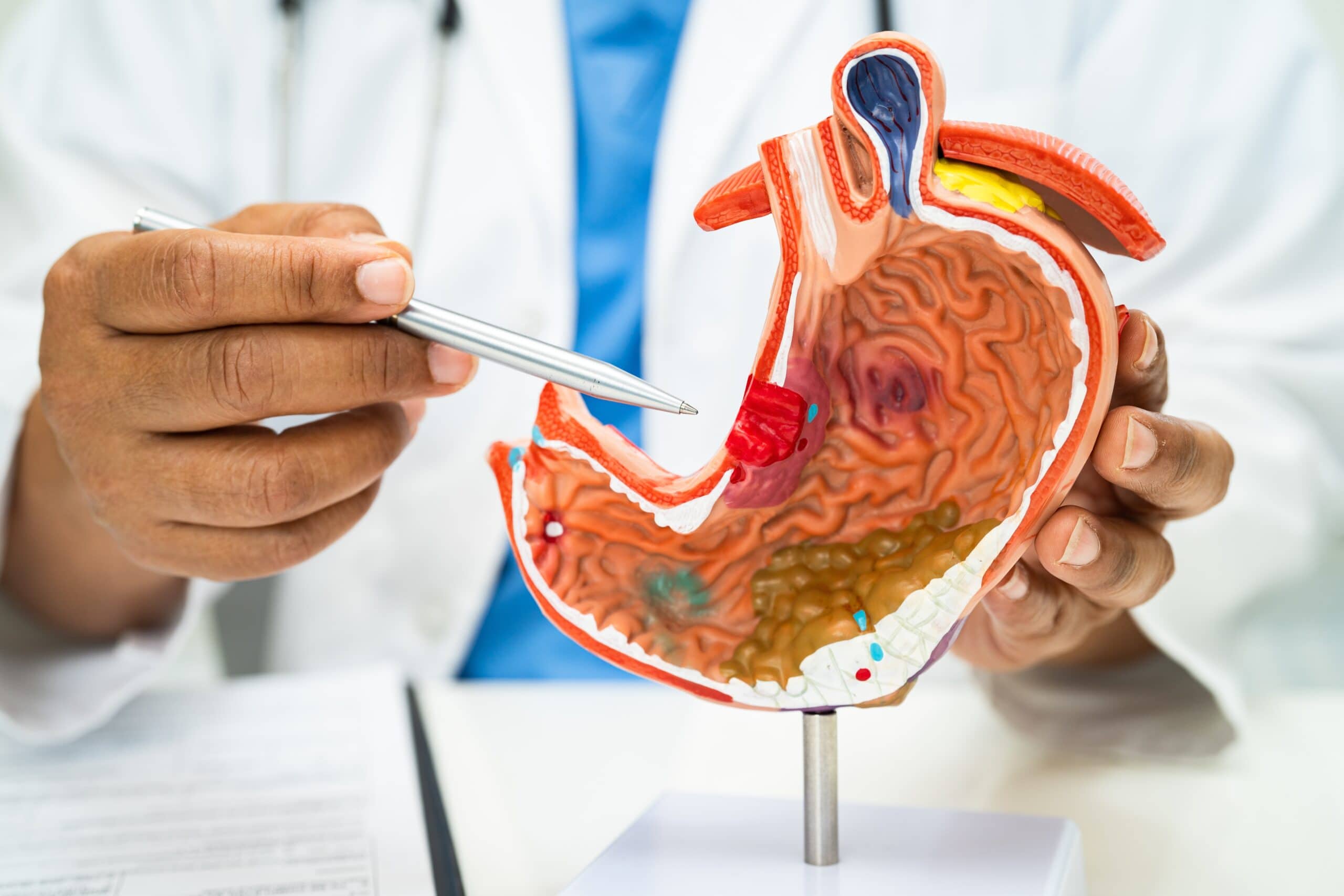 Stomach Ulcers Are Caused by Stress