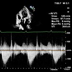 Heart Disease (continued)