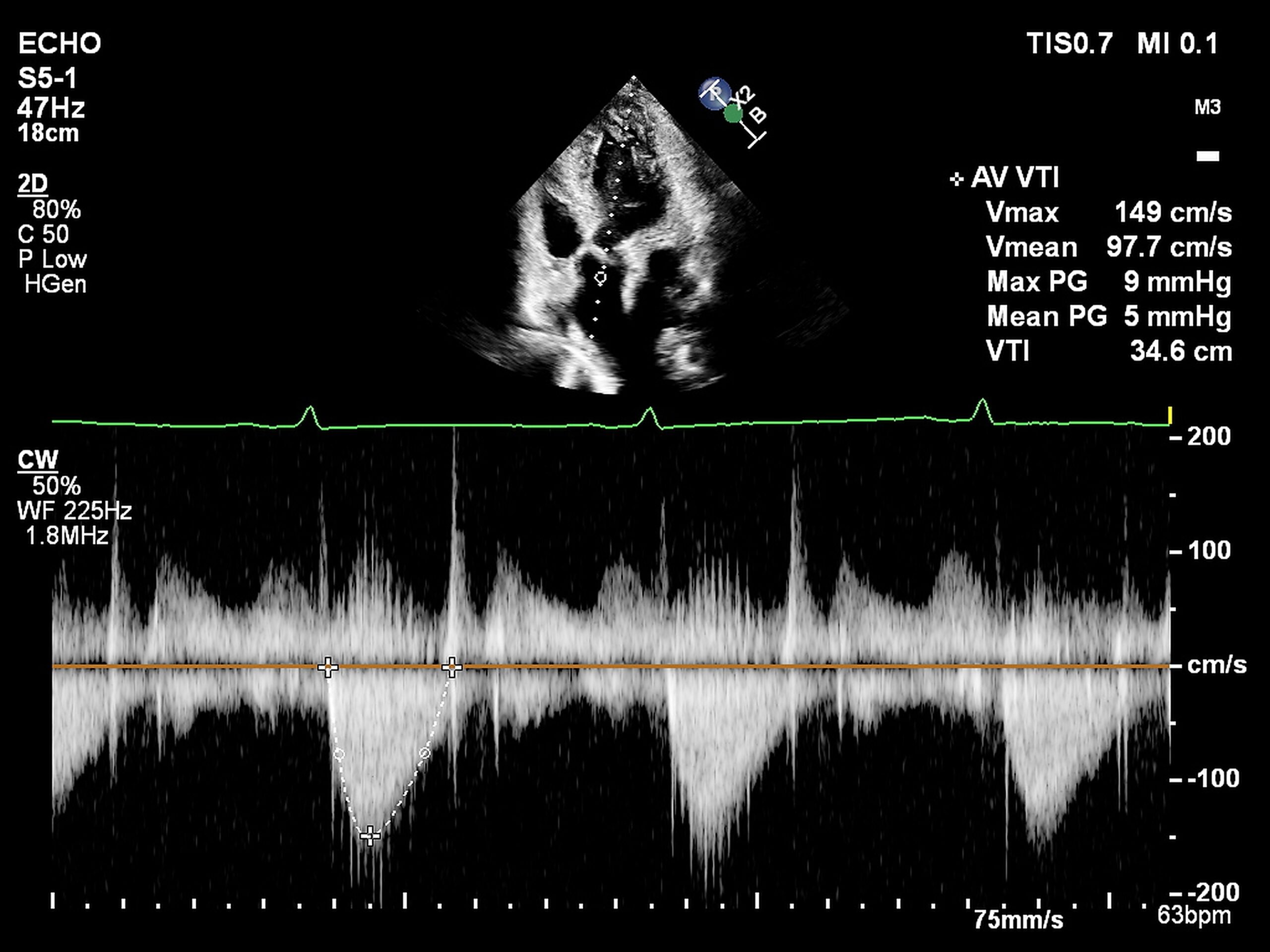 Heart Disease (continued)